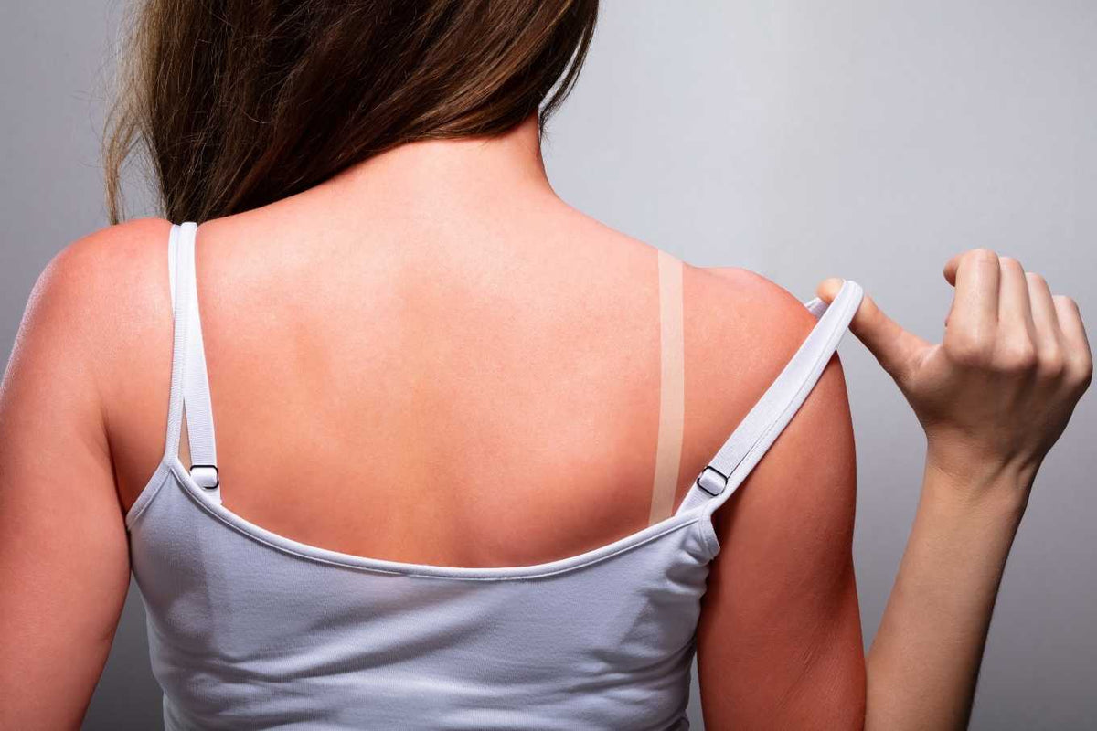 ¿Qué hacer cuando te insolas? Guía para calmar y recuperar la piel después del sol
