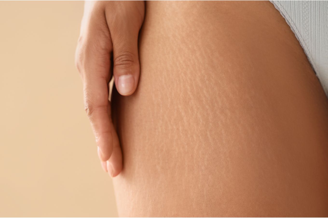Productos para las estrías: guía dermatológica para cuidar y restaurar tu piel