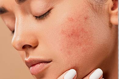Productos Efectivos para el Acné y Cuidado de Piel Grasa